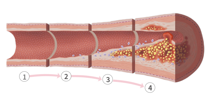 動脈硬化の進展の画像