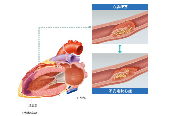 心筋梗塞・不安定狭心症図の画像