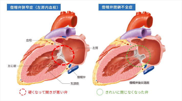 僧帽弁狭窄症・僧帽弁閉塞不全症の画像