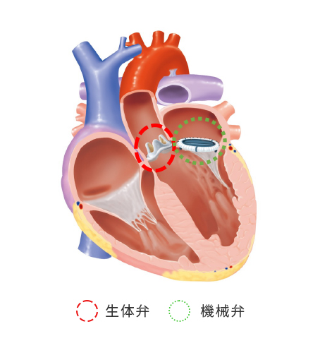 弁置換術の画像