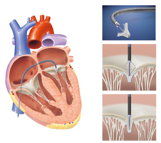 経皮的カテーテル 僧帽弁修復術の画像